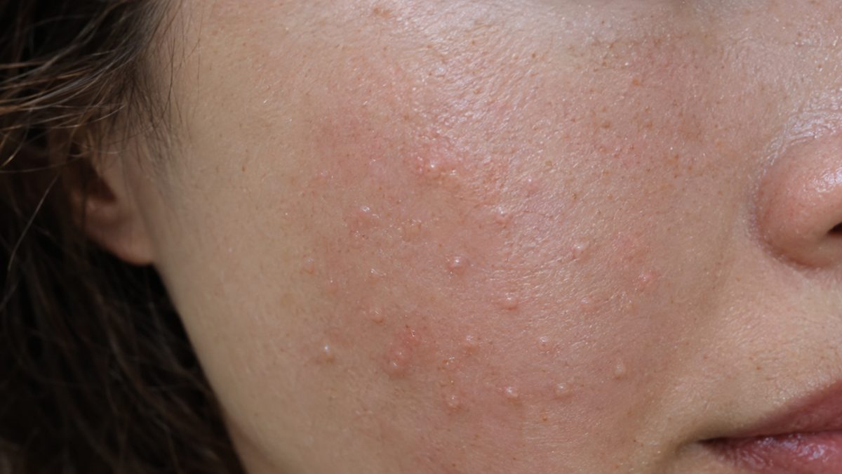 Skin booster bumps and swelling: usually gone in 1-3 days